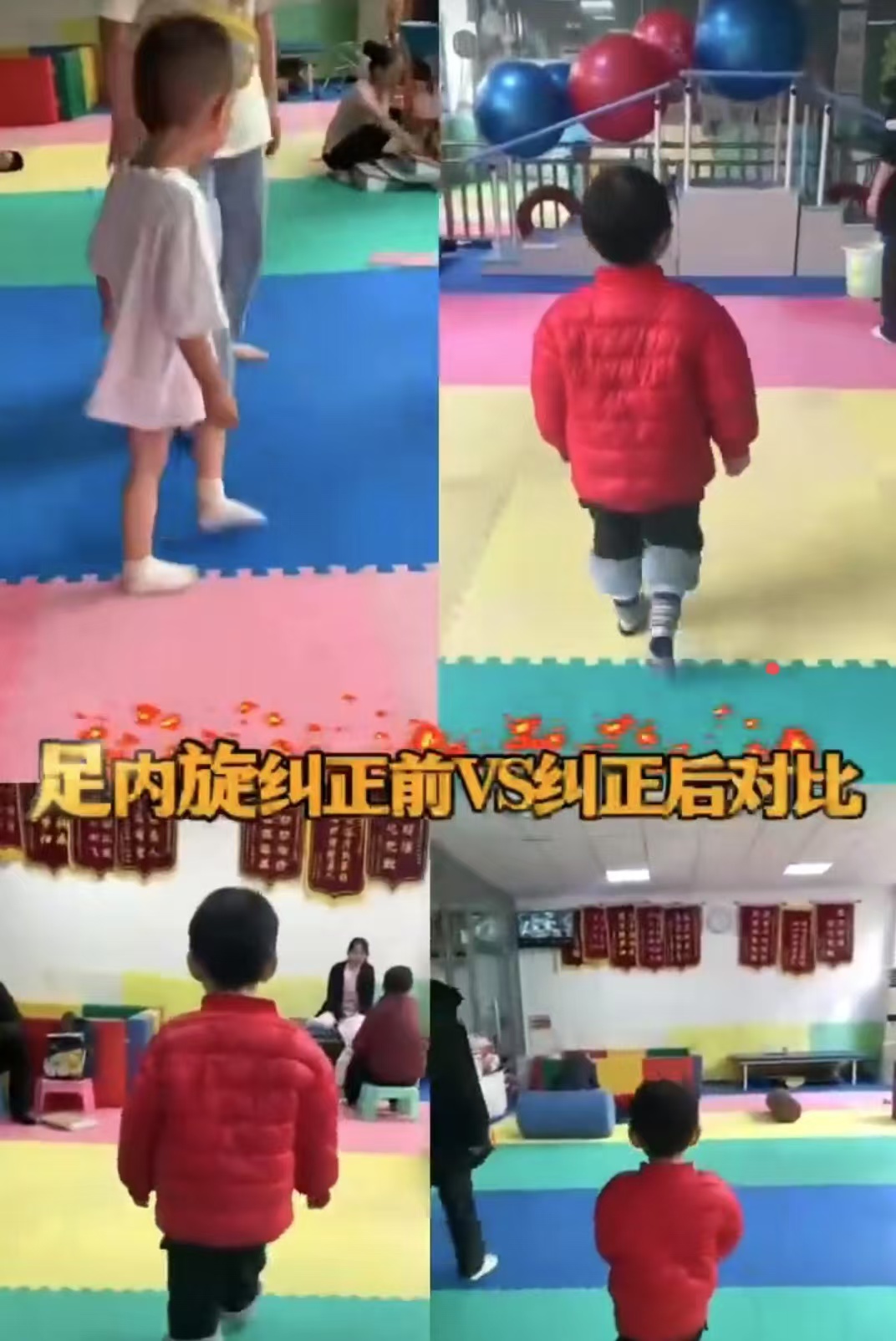 足内旋纠正前VS纠正后